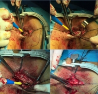 Αντιμετώπιση ορθοκολπικού συριγγίου με κρημνό ορθικού βλεννογόνου και αλληλοεπικαλυπτόμενη σφιγκτηροπλαστική