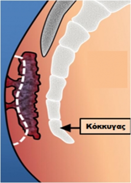 Κύστη κόκκυγος