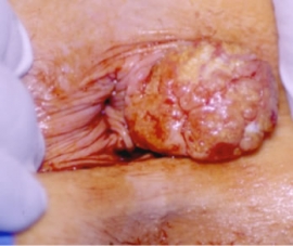 Καρκίνος του πρωκτού