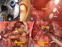 ΤΑΜΙS: Η εξειδικευμένη ελάχιστα επεμβατική προσπέλαση για τη διαπρωκτική αφαίρεση των νεοπλασμάτων του ορθού