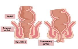 Πρόπτωση ορθού
