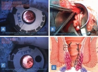 Η μέθοδος της απολίνωσης των αιμορροϊδικών αγγείων και οι παραλλαγές της στην αντιμετώπιση της αιμορροϊδοπάθειας