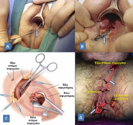Περιπρωκτικά αποστήματα και συρίγγια